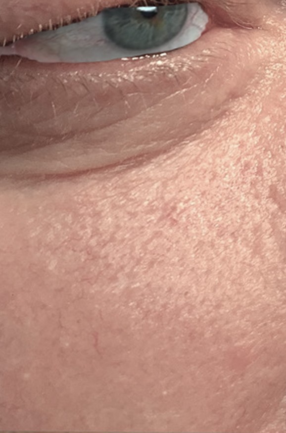 after mohs surgery