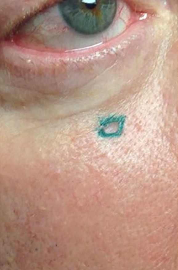 before mohs surgery