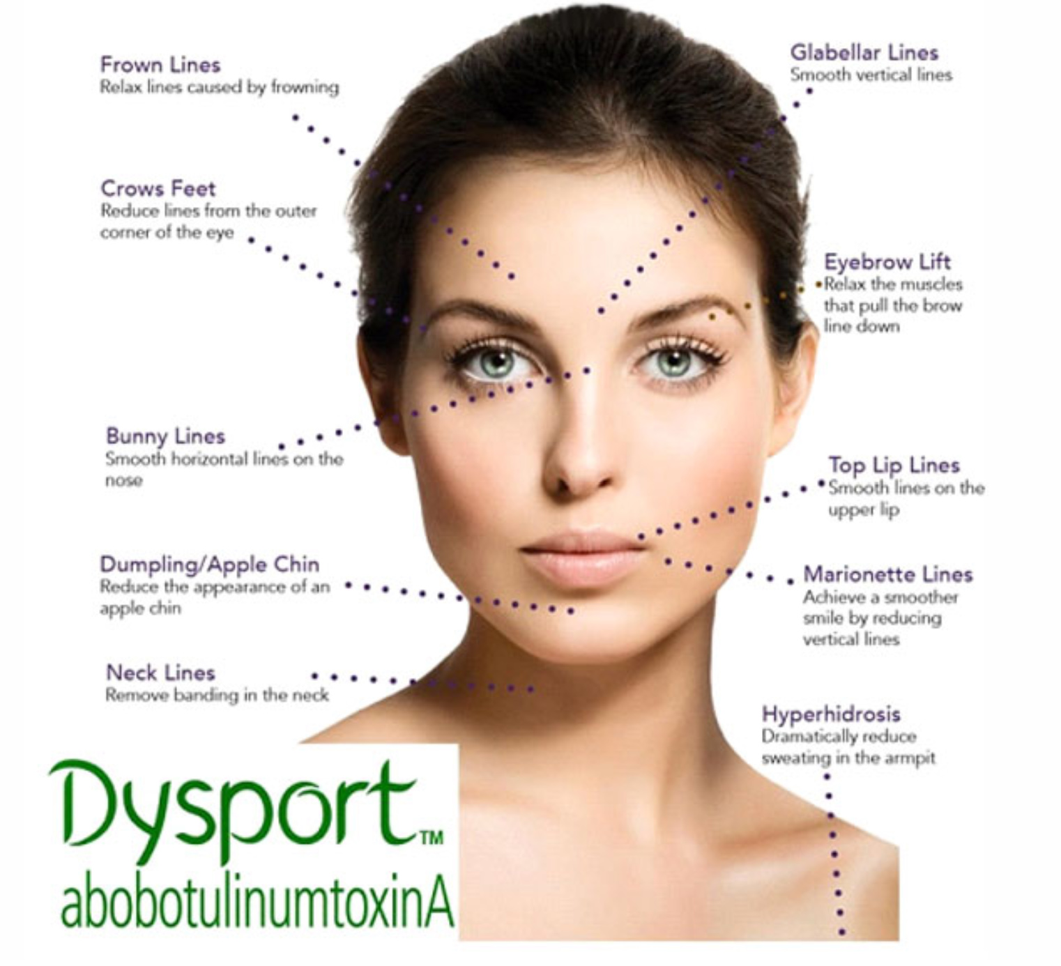 dysport treatment