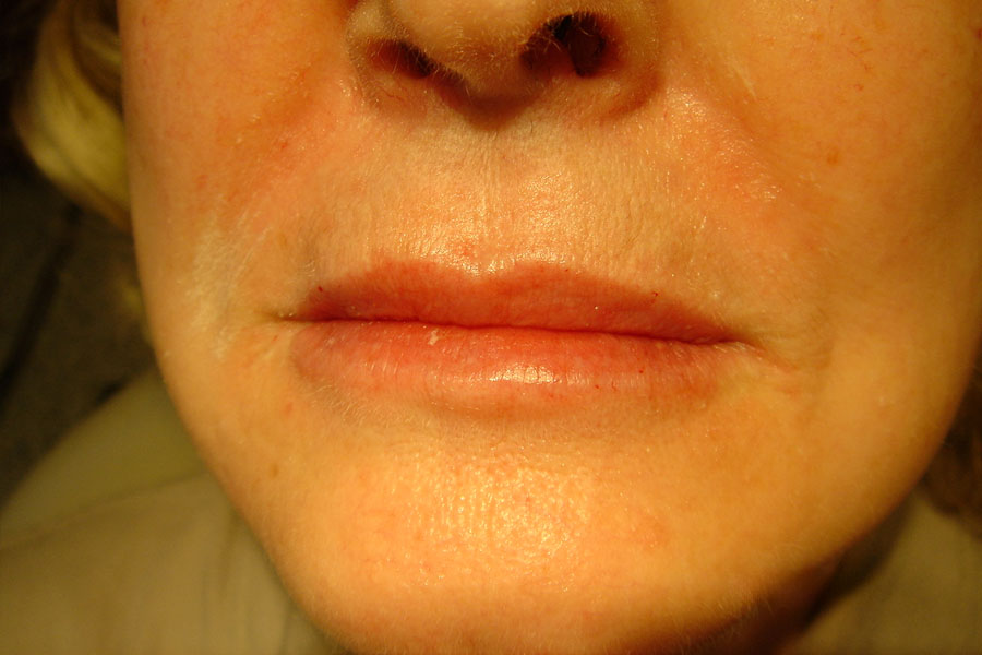 lip filler after