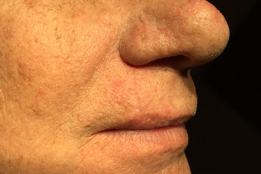 mohs surgery for lip follow up