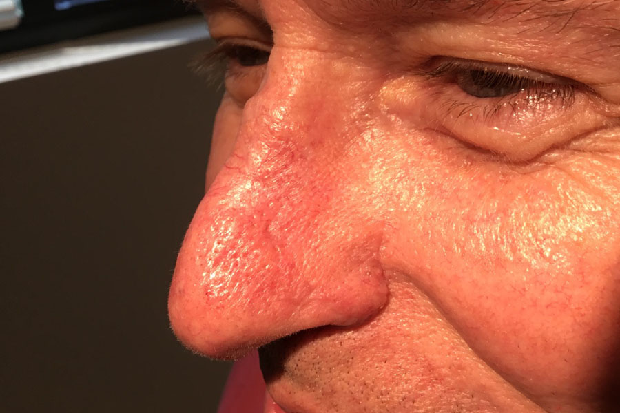 mohs surgery for nose follow up