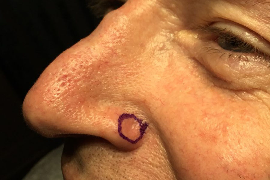 mohs surgery for nose pre op