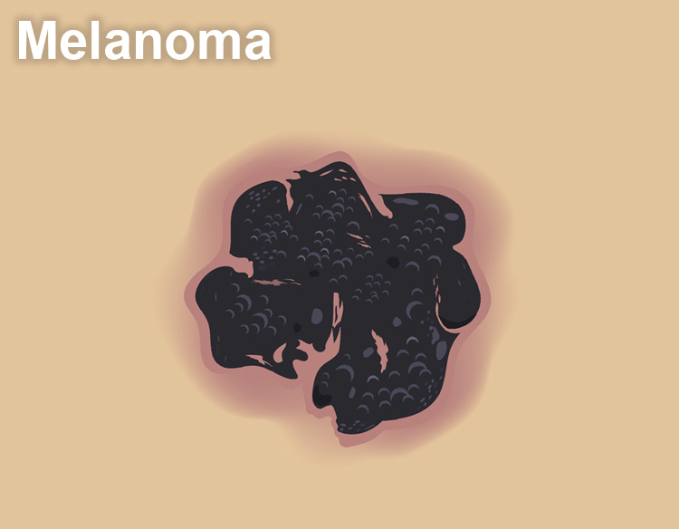 picture of melanoma