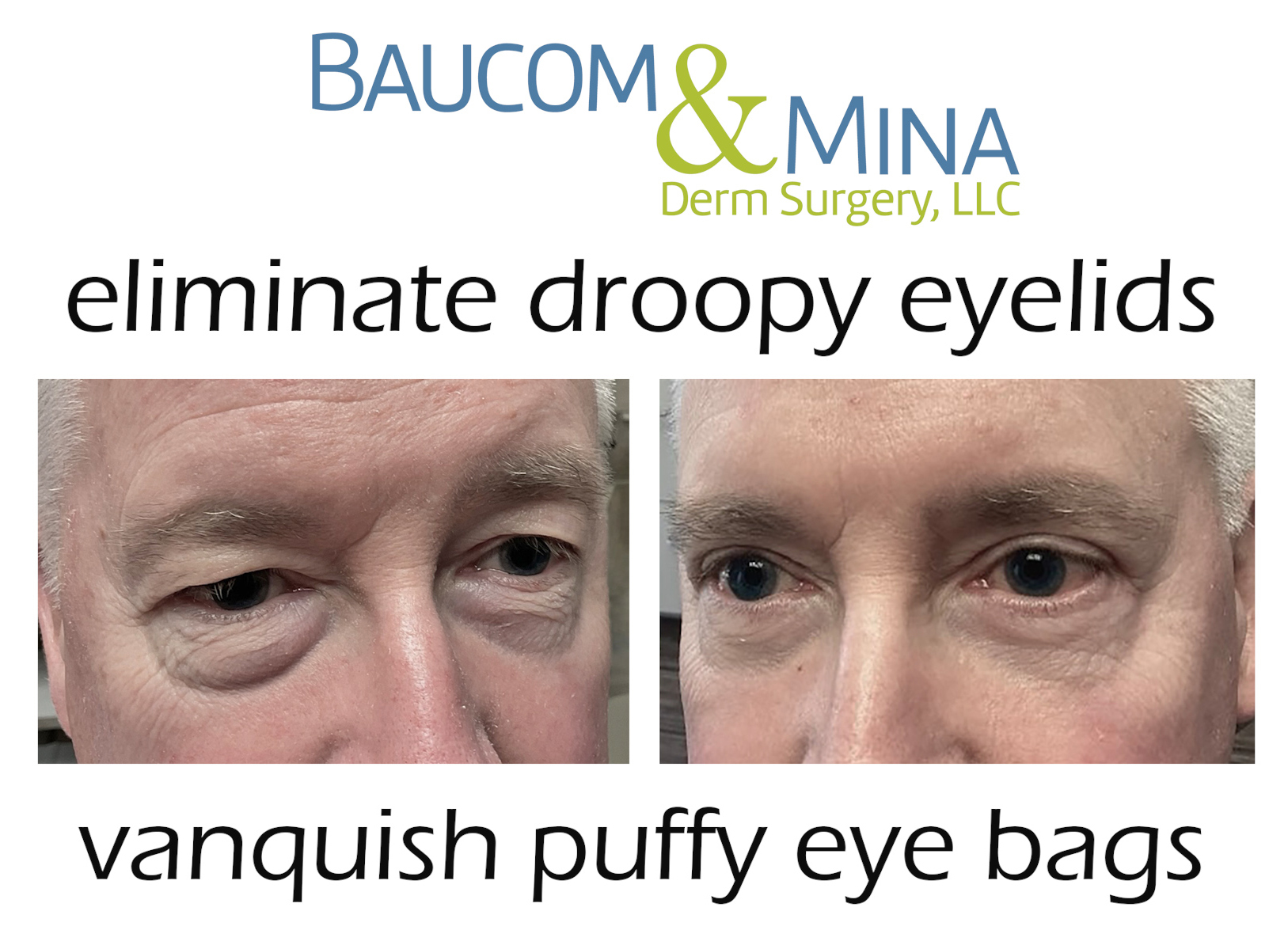 best atlanta eyelid lift surgeons