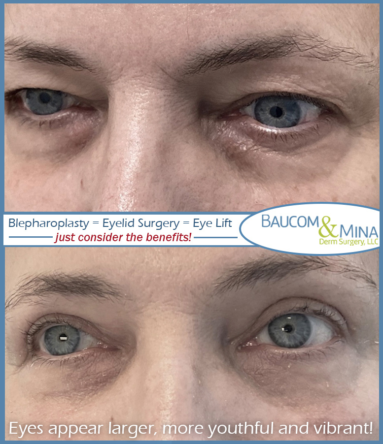 blepharoplasty atlanta