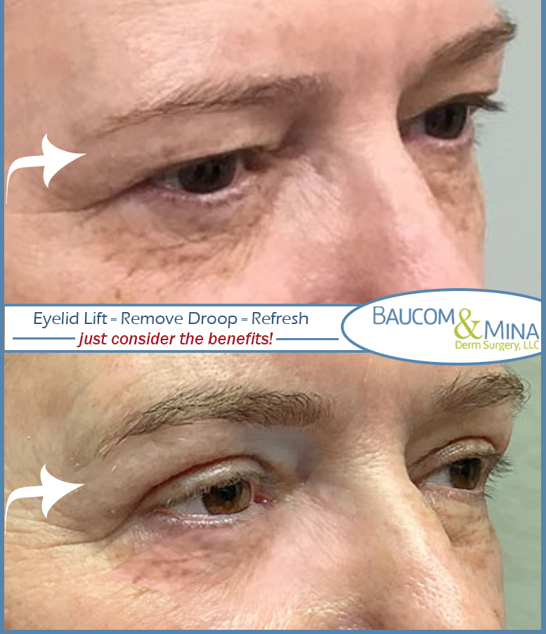 eyelid lift surgery